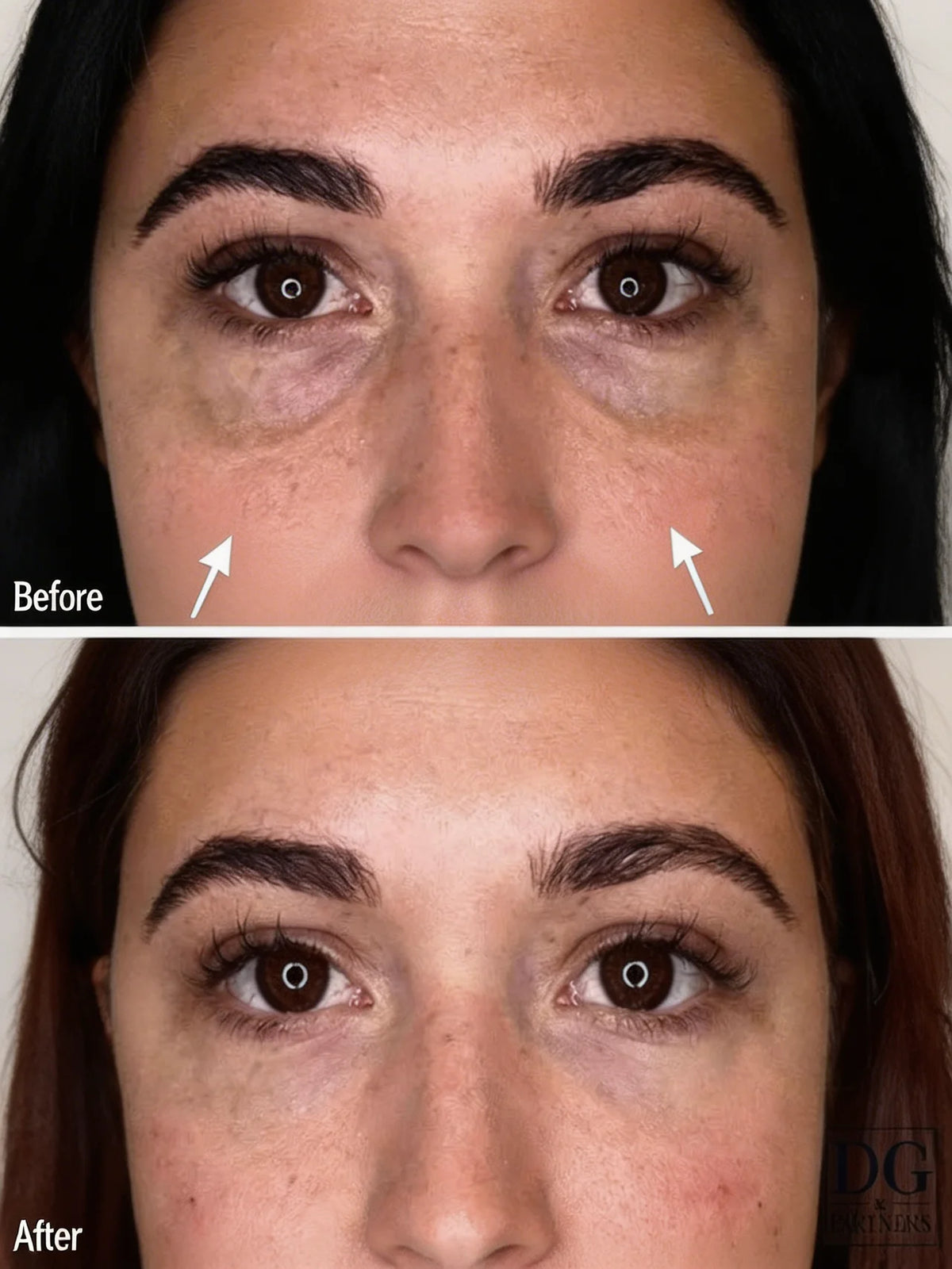 Tensorix Ojeras, Bolsas y Líneas